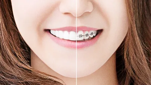 マウスピース型矯正と